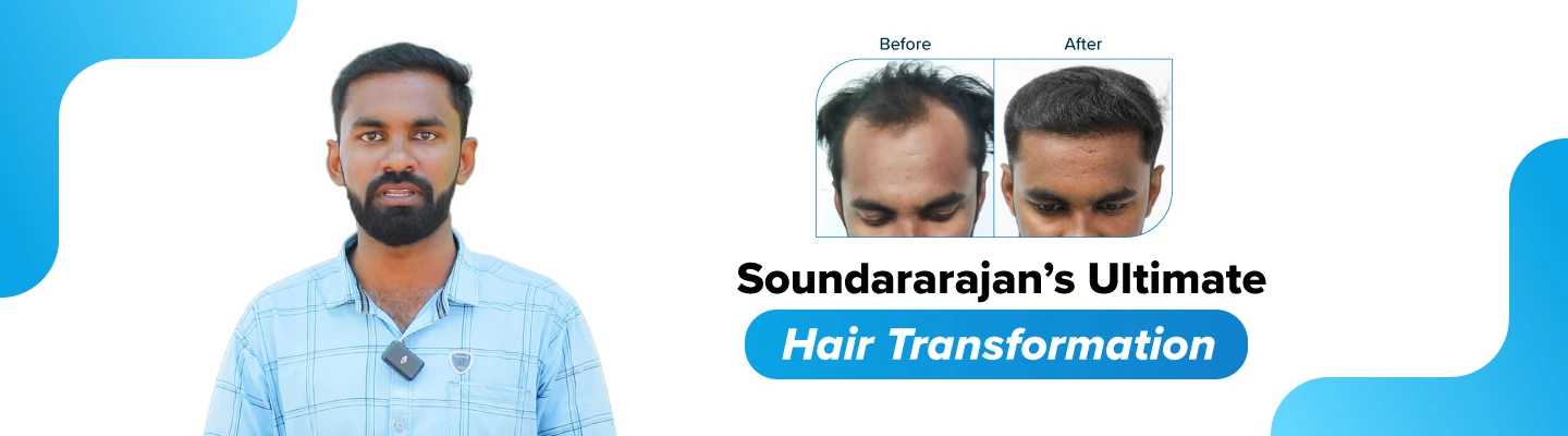 soundararajan-hair-baldness-treatment