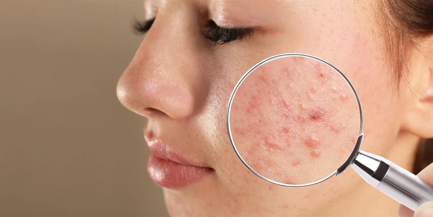 acne scar treatment in chennai