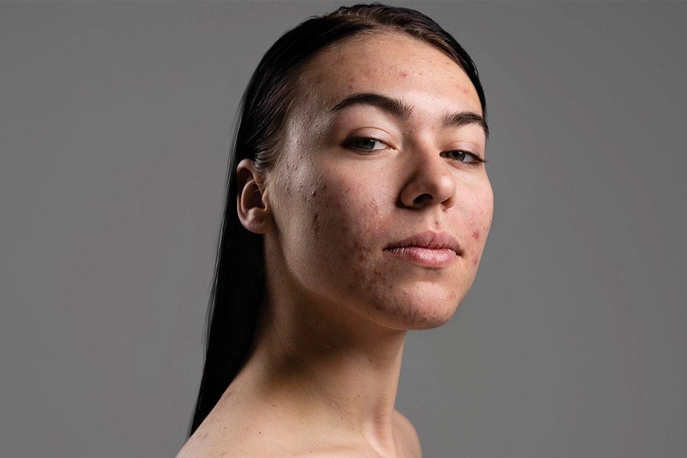 oily skin for acne