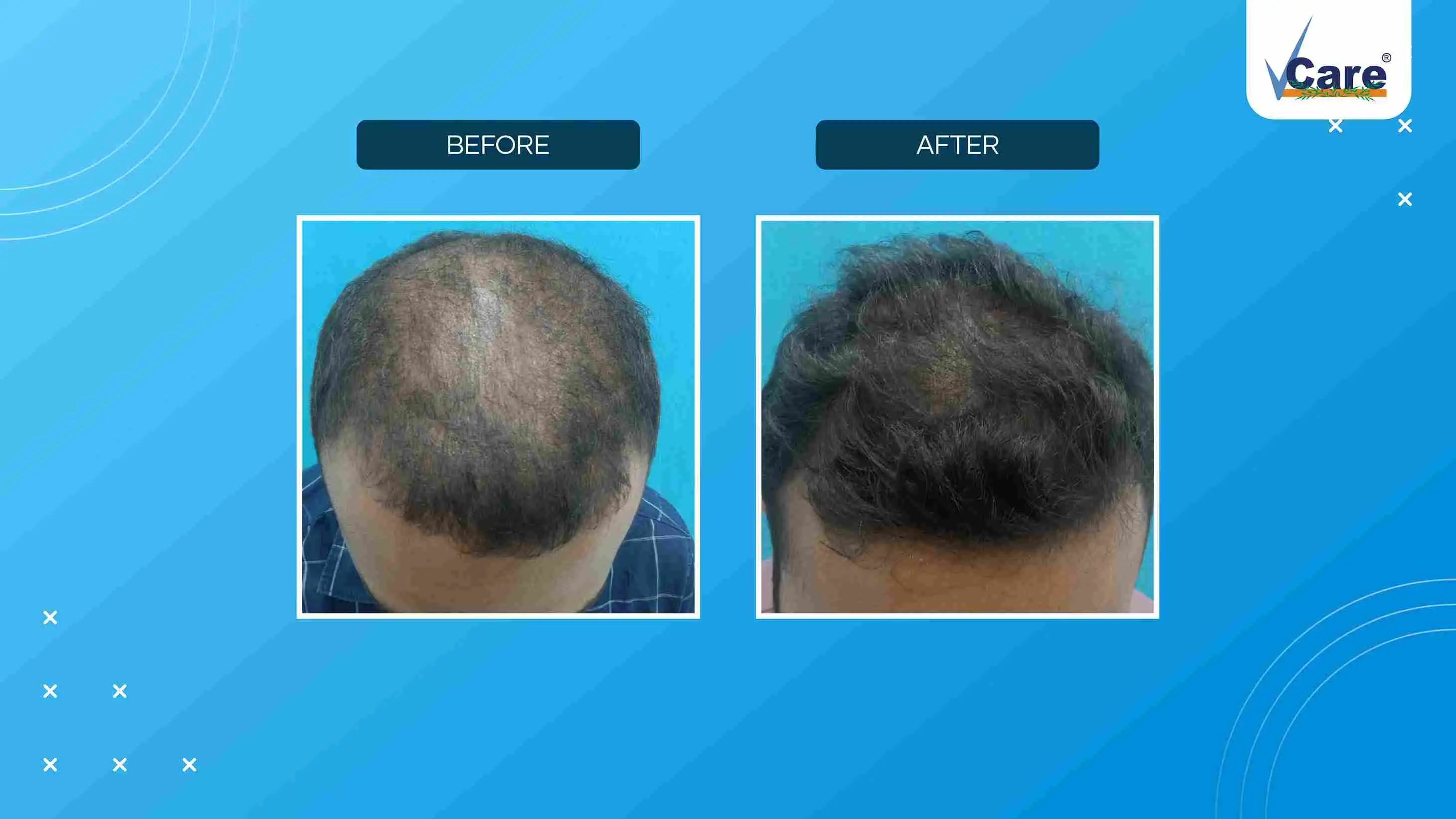 prp hair growth treatment