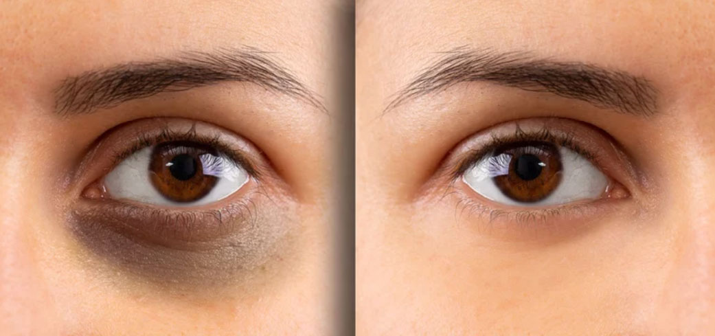 dark circle under eyes