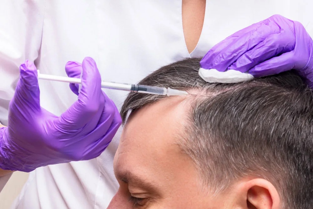 PRP Hair Treatment in Chennai: Procedure, Benefits, Cost Factors & Results