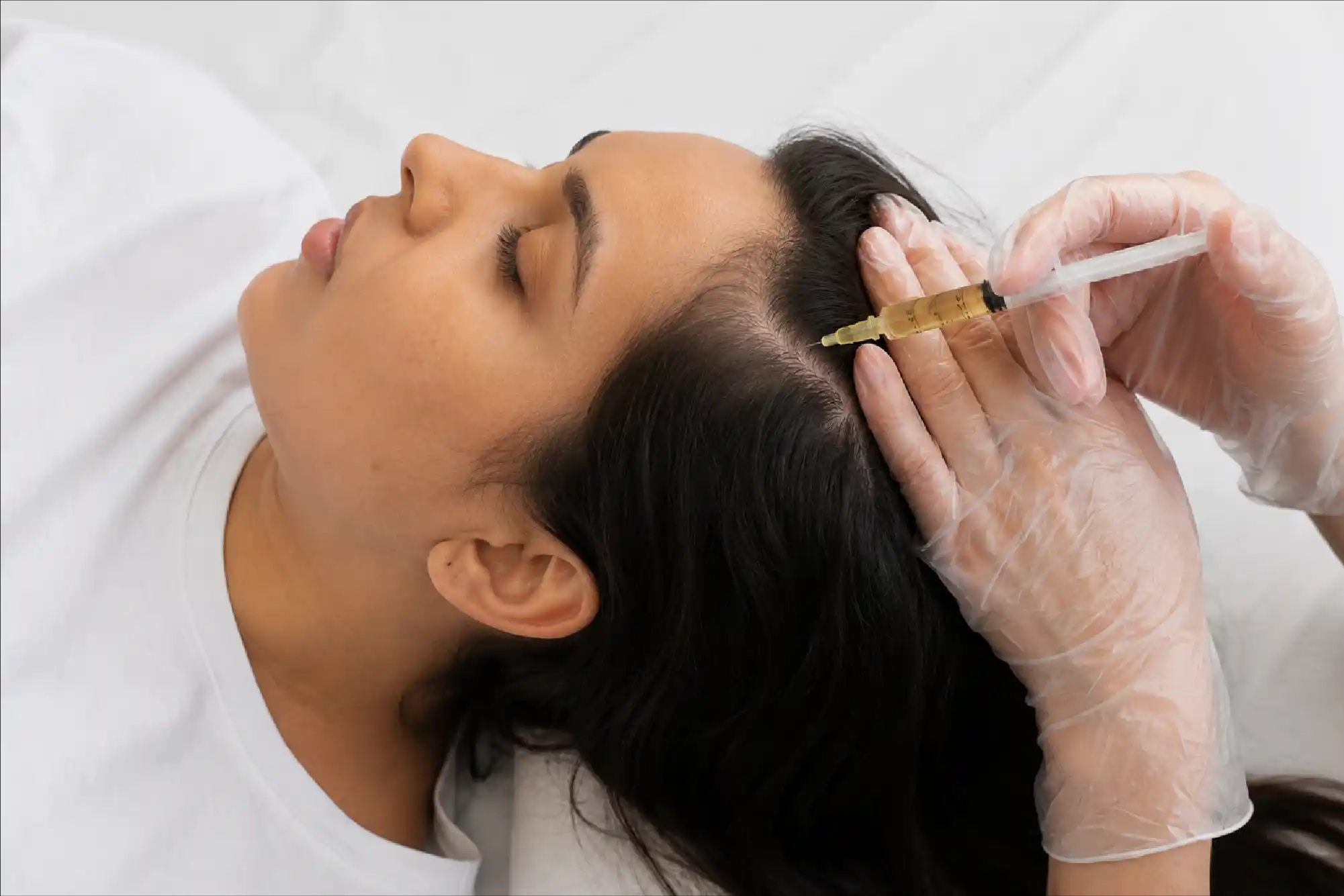 PRP Hair Treatment in Bangalore: Procedure, Benefits, Cost & Results