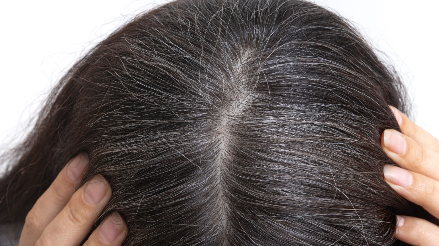 grey-hair-treatment-bangalore