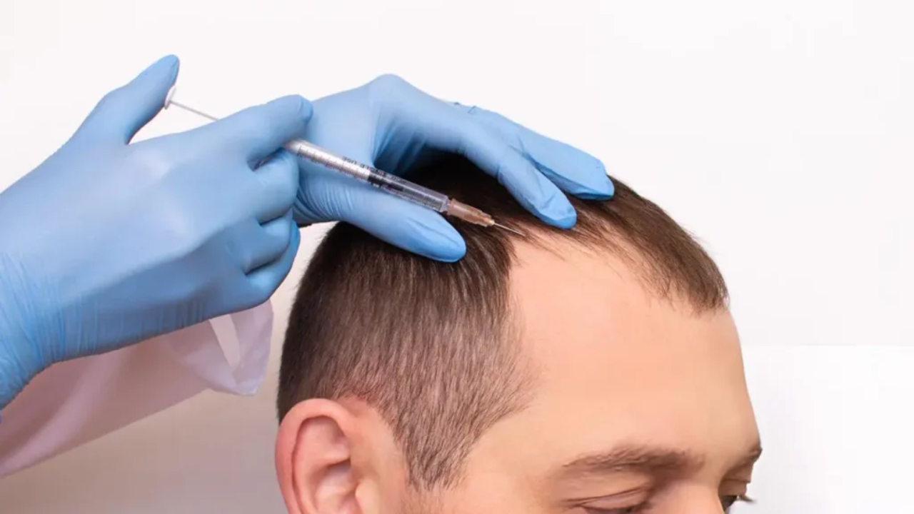 GFC vs PRP Hair Treatment: Which Is Better for Hair Loss?