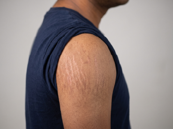 Stretch Mark Removal in Chennai: Are You Treating Them Right or Just Hoping They Fade?