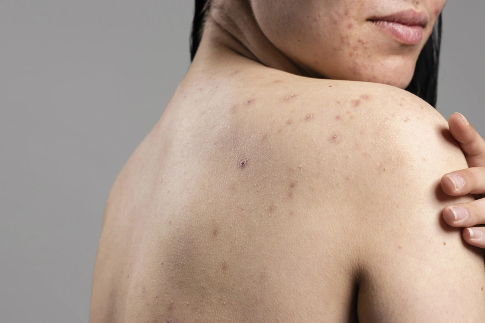 Back Acne: Causes, Symptoms, and the Best Back Acne Treatment Options