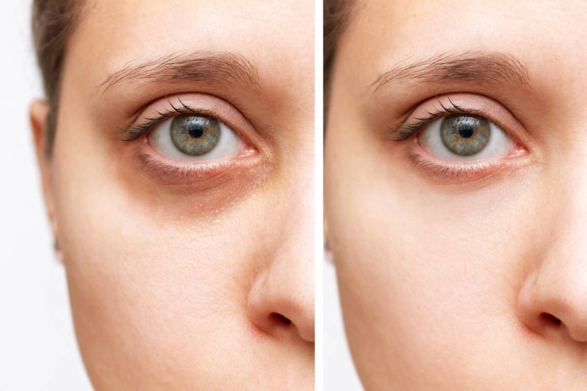 dark circles under eyes