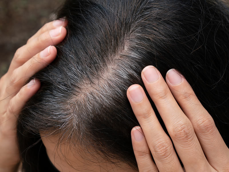 Grey Hair Treatment in Chennai: Expert Care for Premature Grey Hair at VCare