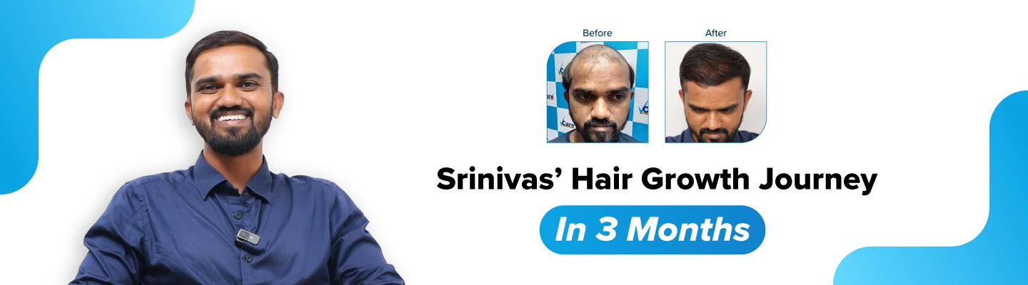 hair growth journey for srinivas