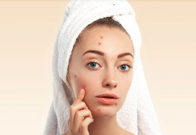 Best Acne Treatment for Oily Skin: How to Choose the Right Option