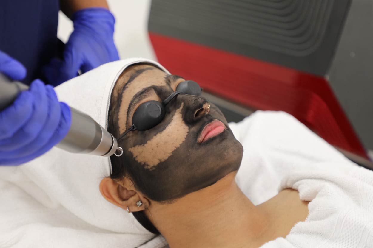 Q-Switch Laser for Pigmentation: How It Works & Benefits