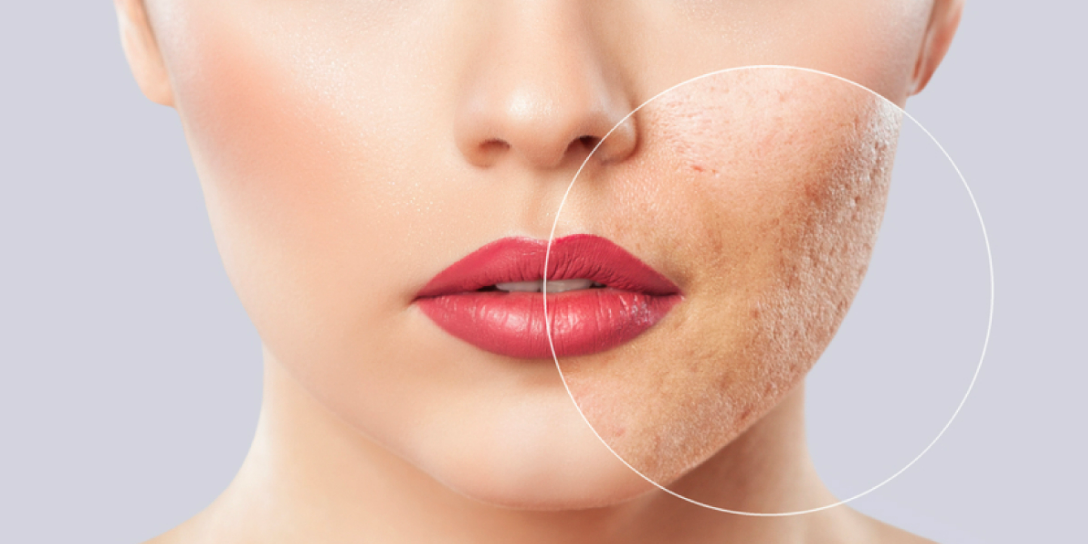 Acne scar treatment