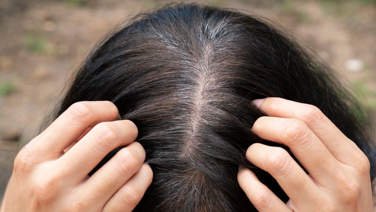 Grey Hair Treatment in Bangalore: Advanced Care for Premature Grey Hair at VCare