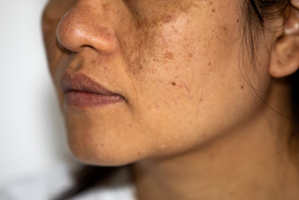 hyperpigmentation
