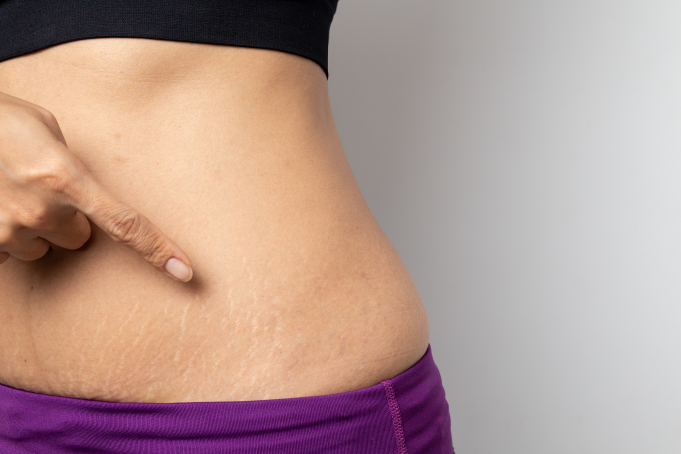 Stretch Mark Removal in Bangalore: Are You Treating Them Right or Just Hoping They Fade?
