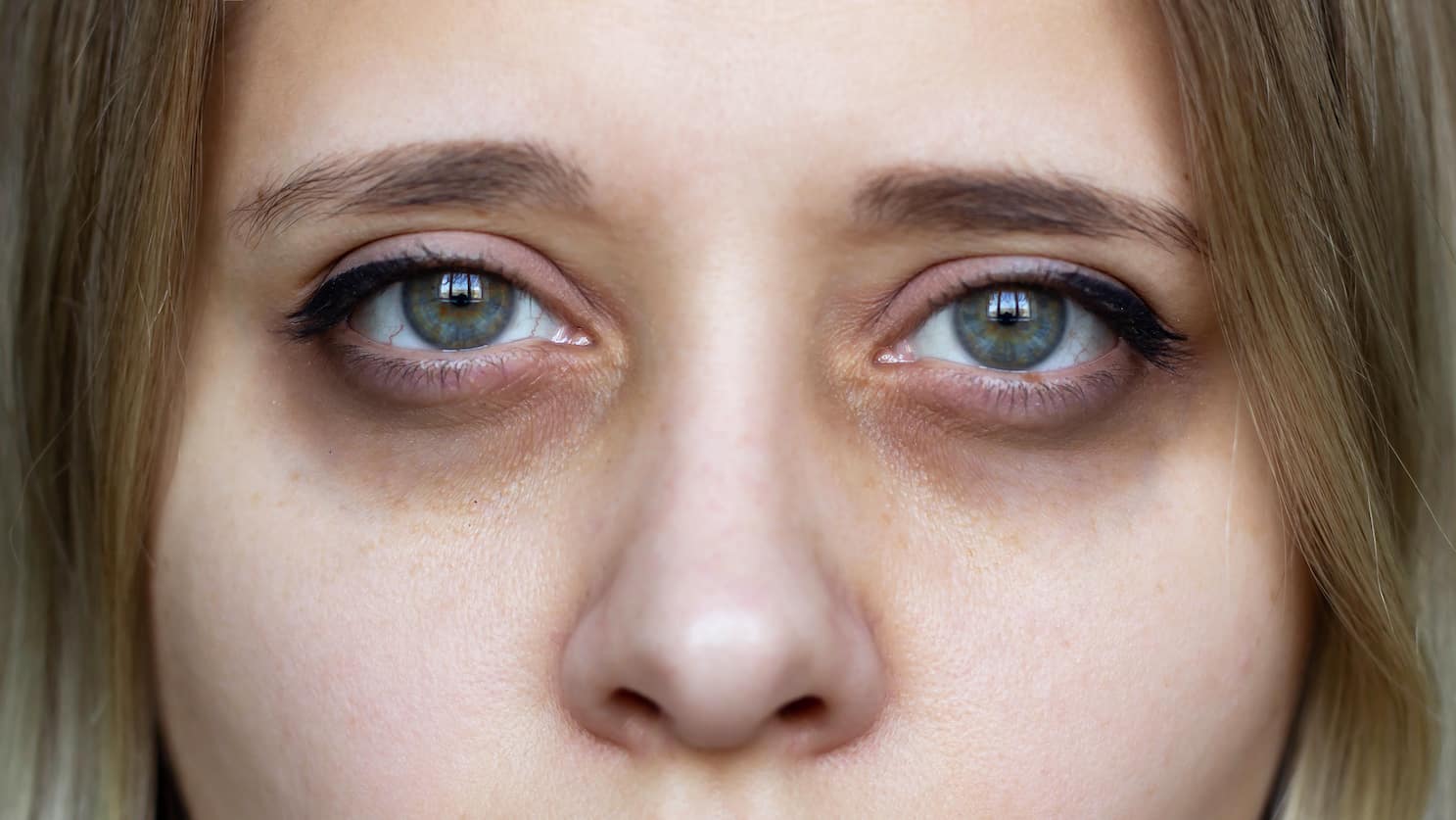 dark circles under eye treatment